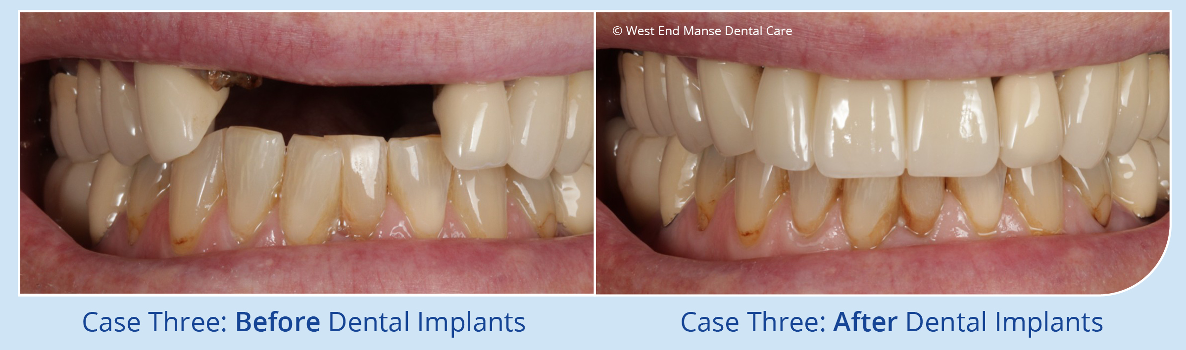 Haverhill Dental Implants